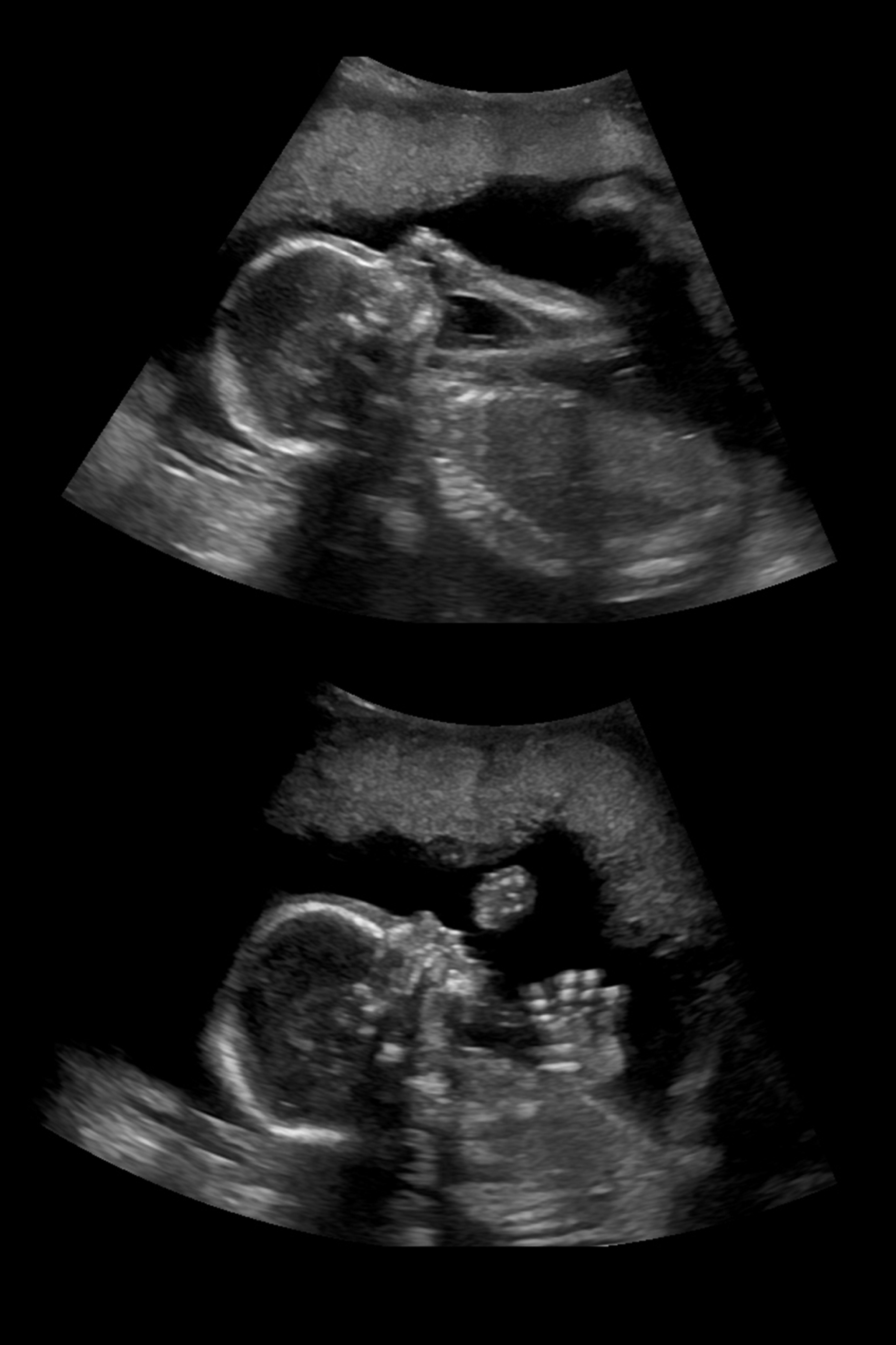 20 Weeks Pregnant, Gender Reveal